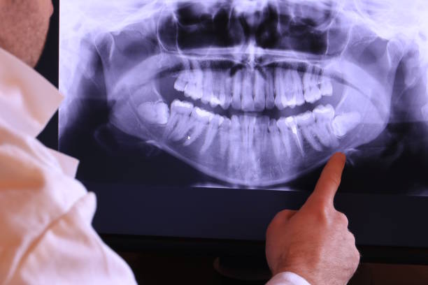 Best Emergency Wisdom Teeth Removal in Clinton, LA