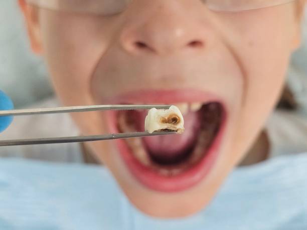 Best Emergency Broken Tooth Repair in Clinton, LA